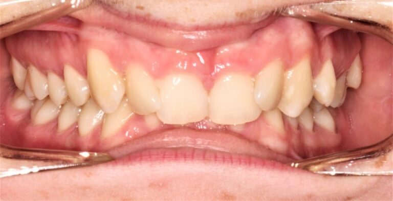 Before & After - Insight Orthodontics