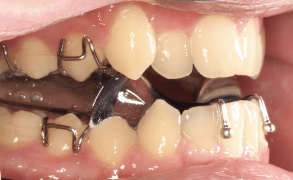 Functional Appliances Treatments Insight Orthodontics